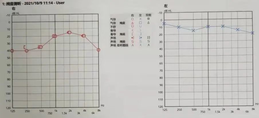14张听力图,细说梅尼埃病典型疾病进程及阶梯化治疗丨"晕"筹帷幄·第3