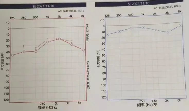 14张听力图,细说梅尼埃病典型疾病进程及阶梯化治疗丨"晕"筹帷幄·第3