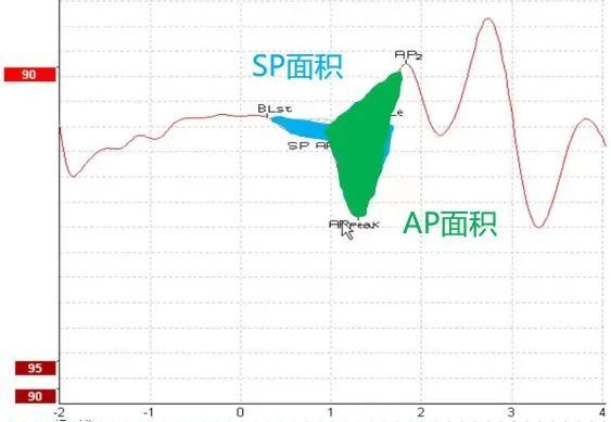 14张听力图,细说梅尼埃病典型疾病进程及阶梯化治疗丨"晕"筹帷幄·第3