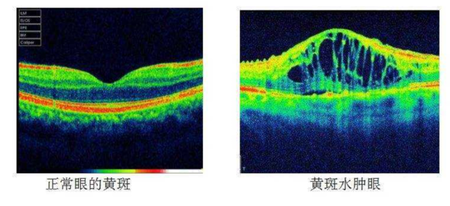 久患糖尿病 视物变形小心眼底黄斑水肿