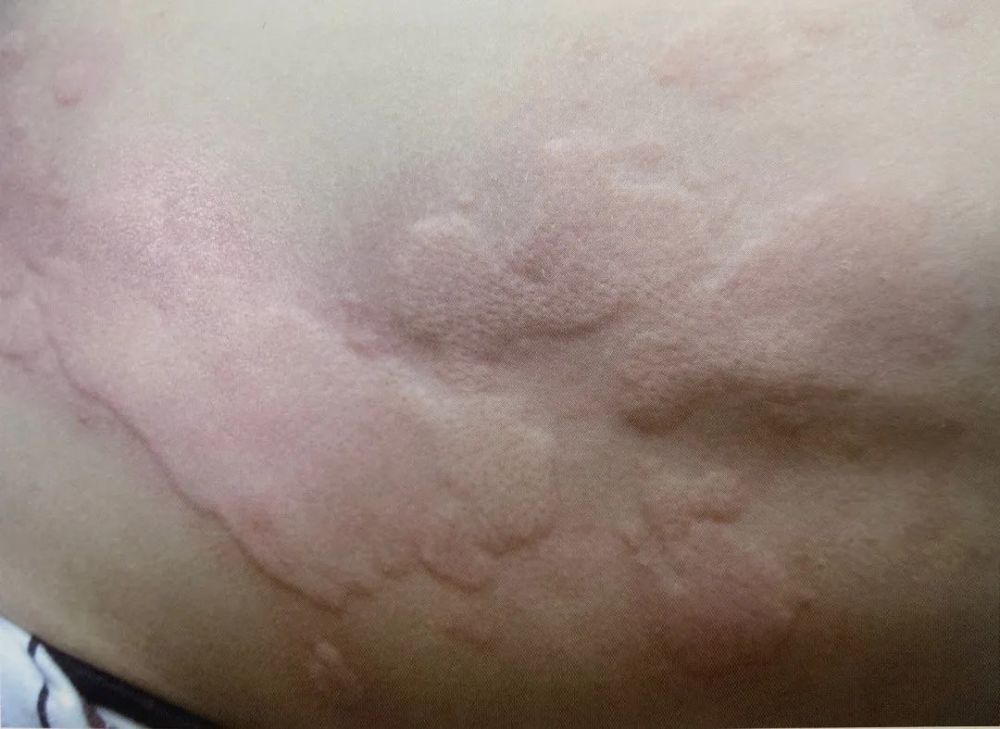 荨麻疹02推荐就诊科室:皮肤科小知识:阳光不会加重湿疹,也不会改善