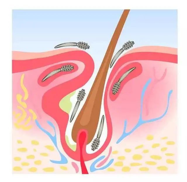毛囊蠕形螨手绘图图片