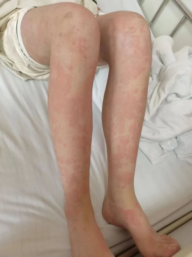 用了"神器",浙江一女生全身发红,瘙痒难忍!医生提醒