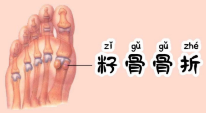 运动损伤,警惕籽骨炎_腾讯新闻