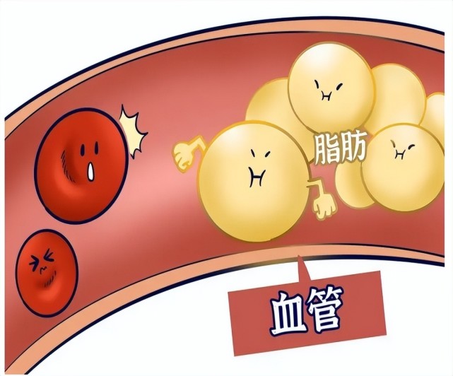 甘油三酯,磷脂和非游离脂肪酸等,多由于脂肪代谢或运转异常造成