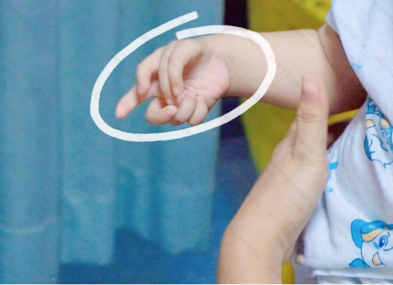 男孩右手7根手指虽然看起来很美但没有功能还能治好吗