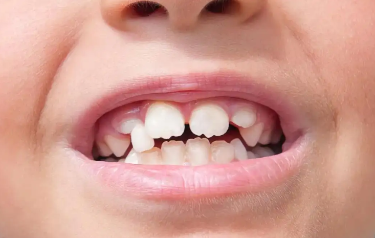 牙齿畸形是指,儿童生长发育过程中,牙齿表现出排列不齐,拥挤,错位等