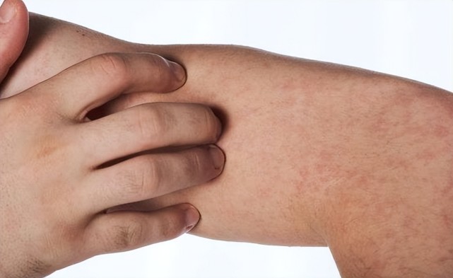 药物如果患者在服用青霉素,磺胺,阿司匹林等药物,或者注射抗破伤风