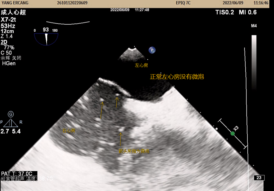 院内首例深圳恒生医院成功开展经食管右心声学造影检查