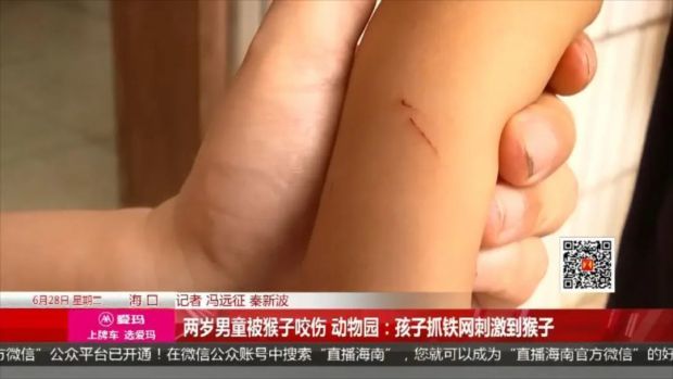 事发海口两岁男童被猴子咬伤手指抓伤手臂动物园回应