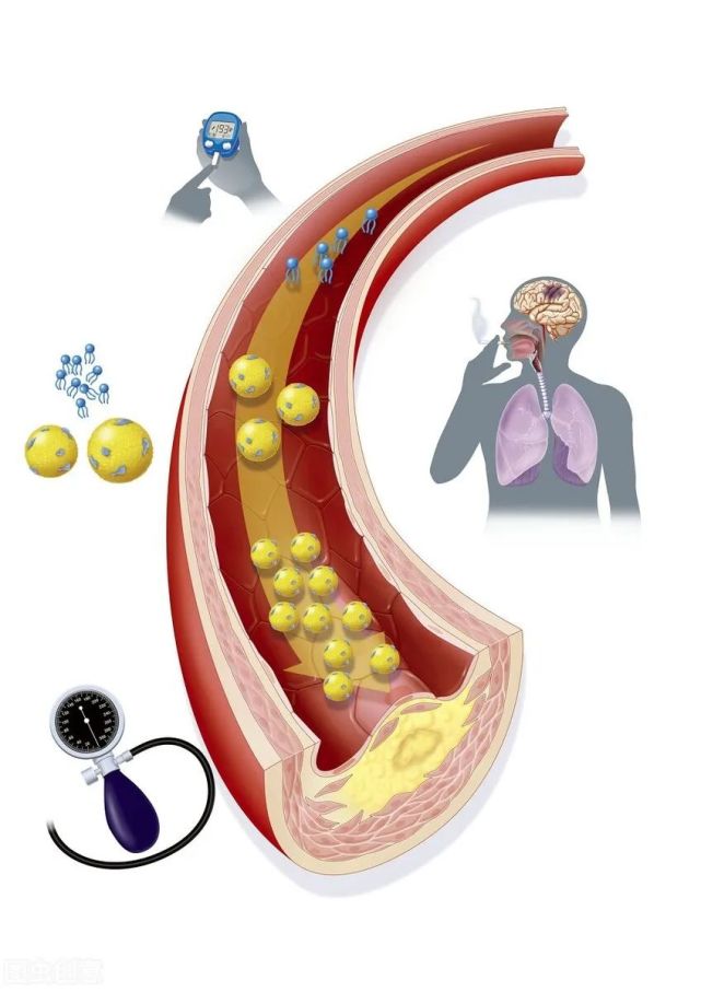 若血管堵塞到一定程度,脂質斑塊被衝拖,就可能誘發心梗,腦梗等嚴重