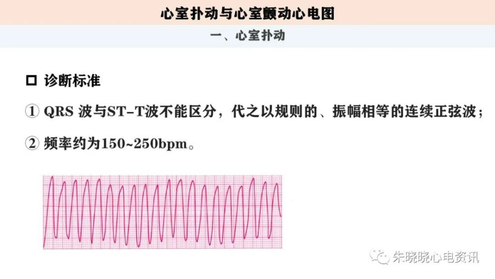 心室撲動與心室顫動心電圖