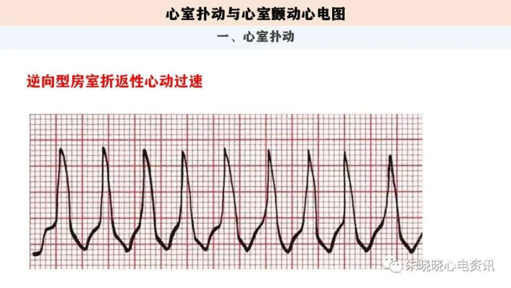 心电图解读室扑与室颤心电图ppt