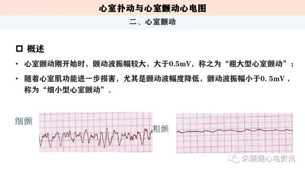 心電圖解讀:室撲與室顫心電圖(ppt)_騰訊新聞