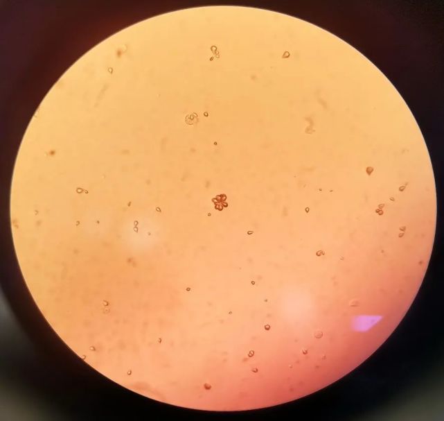 工作中不乏惊喜,常见的草酸钙结晶也有"泪滴形"