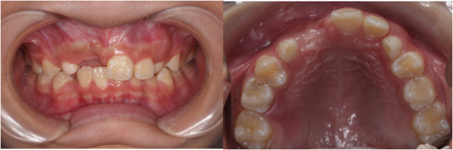小朋友乳牙掉了一直没长新牙怎么办?