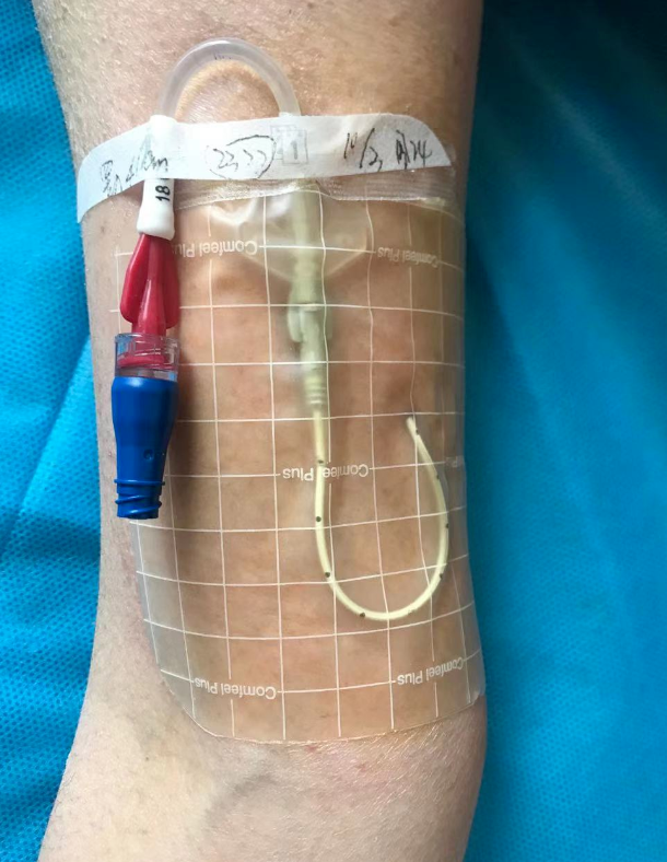 picc贴膜导致严重的皮肤过敏该怎样处理?