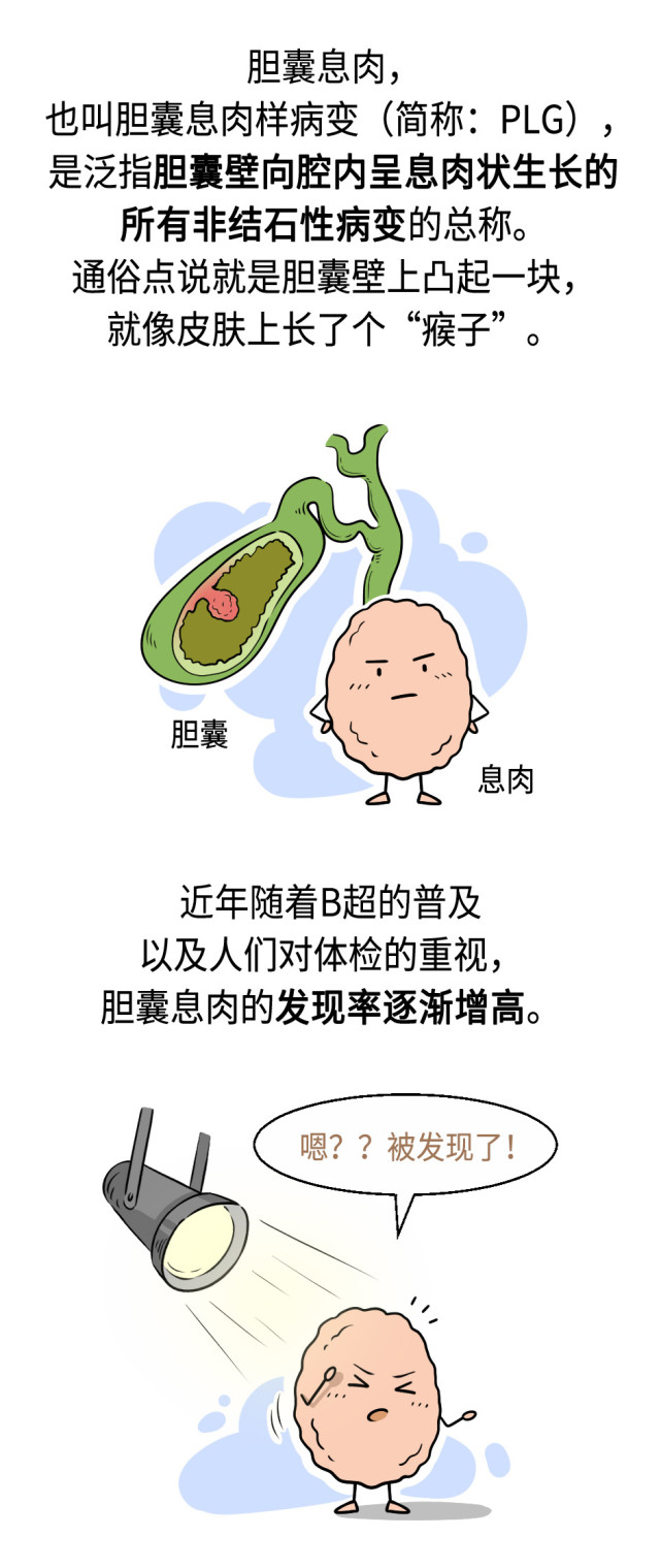 长了胆囊息肉只能将胆囊摘除吗?_腾讯新闻