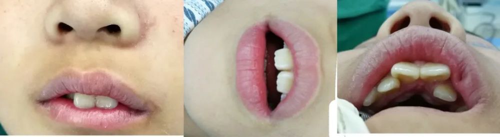 前门牙往外龅脸型慢慢变得又长又窄可以说,口呼吸一天两天没关系,但