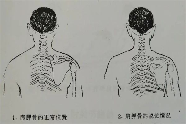 出现明显肩胛骨突出,可能是脊柱侧弯