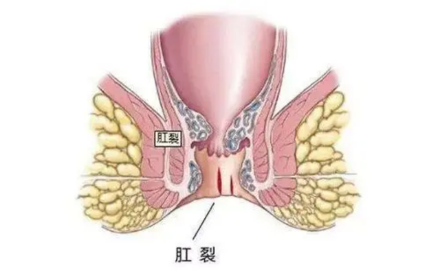 肛肠科医生教你认识肛裂:小小裂口却能给你不一样的痛