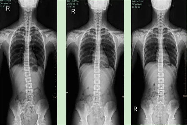 通過x光線平片來看,彎曲角度大於10度,那麼就可以確診為脊柱側彎患者.