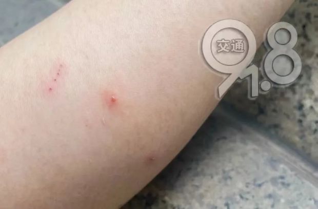 "医生看了口子,说长得不是特别像蝙蝠咬的,但不排除可能,出于预防考虑