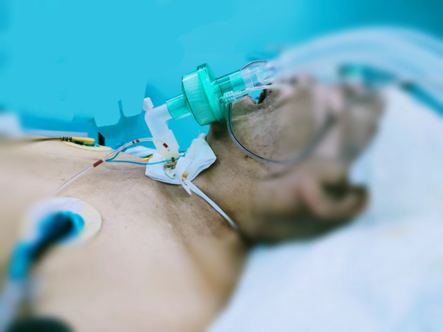 第三次抢救后因无法自主呼吸,icu医生给予气管插管后呼吸机维持呼吸.