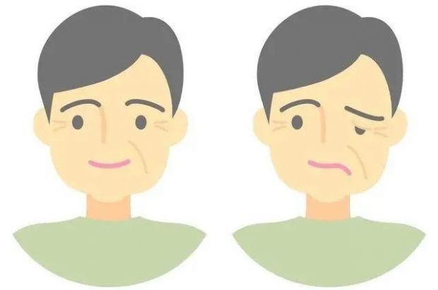 面瘫,也称之为面神经麻痹:急性起病,主要表现为患侧面部表情肌瘫痪,口