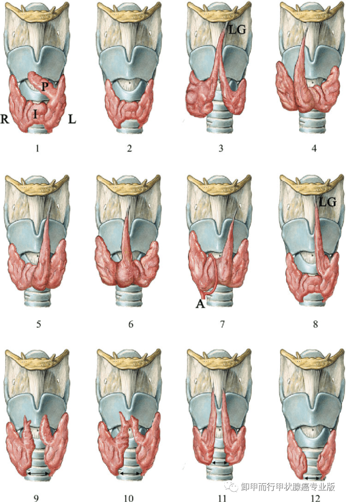 可能峡部缺如可能异常增大,可能无锥状叶或者多个锥状叶02副甲状腺和