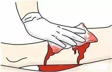 当看见伤口流血,最常做的急救动作就是用手按住出血区,这就是压迫止血