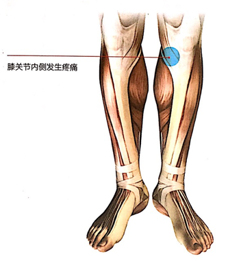 右膝关节活动度正常,无弹响,在关节内侧缘及下方均有压痛,vas疼痛评分