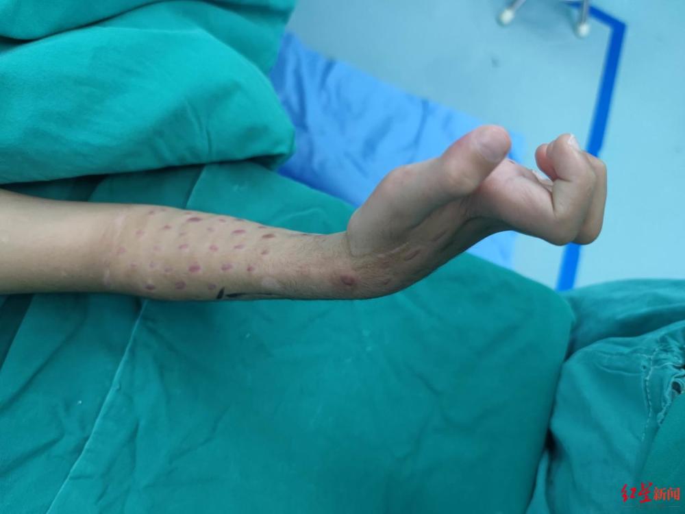 "肖成伟说,缺血性肌挛缩一旦发生,如果不及时治疗,就会导致儿童残疾.