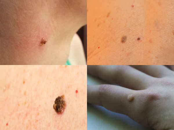 身上的这种小红点是病毒感染,小心越长越多