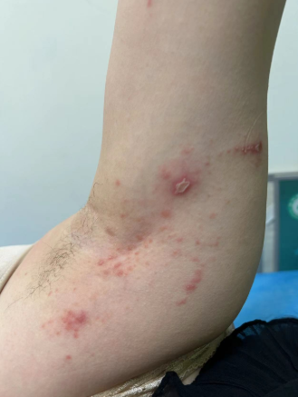 男子户外拍死飞虫 手臂上竟长出脓包