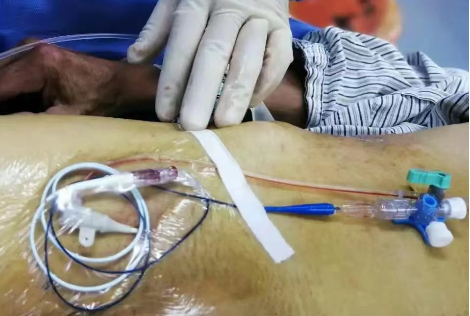 延安市人民医院肿瘤血液科成功施行延安地区首例持续肝动脉灌注化疗ha