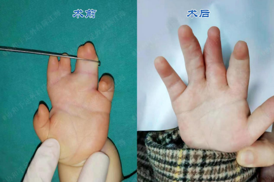 宝宝双手复杂并指"粘连"严重,手术一次能否分好不从身上植皮呢?