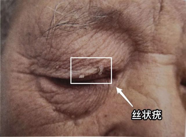 丝状疣,又称「线瘊」「丝瘊」,和人乳头瘤病毒(hpv-2)感染皮肤或黏膜
