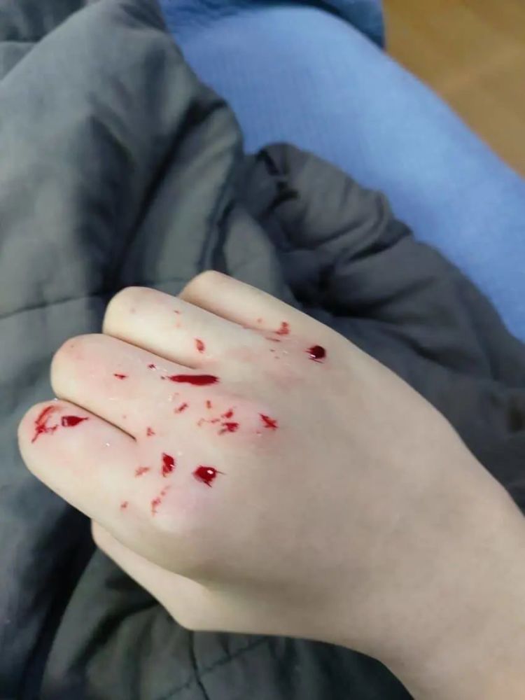 有些人甚至会砸自家的窗户玻璃,砸到拳头出血.