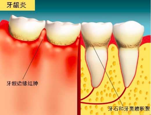 90%人有牙齦炎的口腔護理危害,20大注意事項!