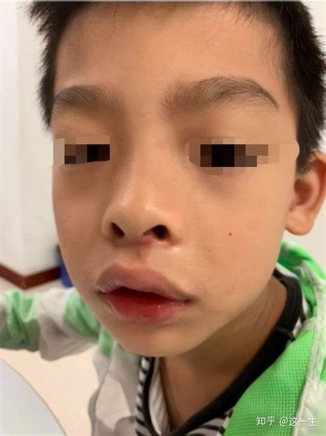 腺样体面容长什么样?怀疑腺样体肥大怎么办_腾讯新闻
