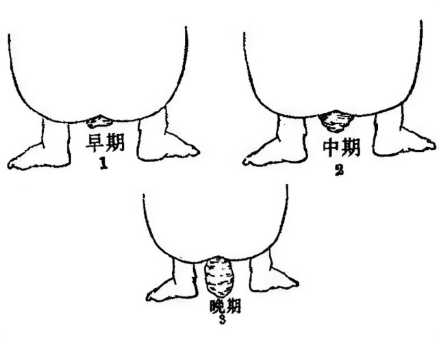 温州医博肛肠医院:脱肛长期不治危害大吗?