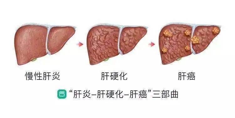 肝硬化离肝癌只差一步,关注身体这5大变化,做到早发现早治疗!