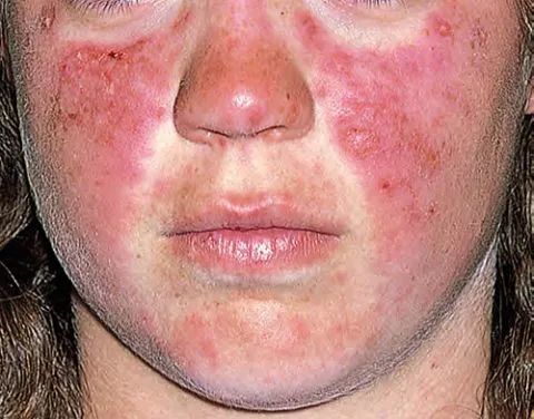 面部脂溢性皮炎怎么治疗最彻底(面部脂溢性皮炎怎么治疗最彻底面)