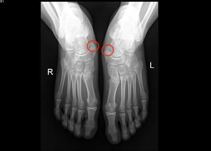 左足舟骨位置图片图片