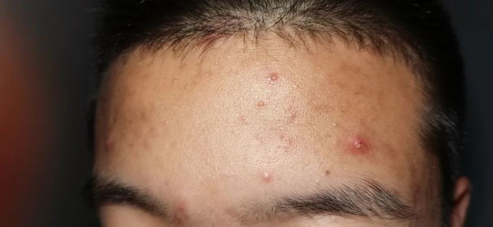 认识一下 青少年寻常痤疮插图1