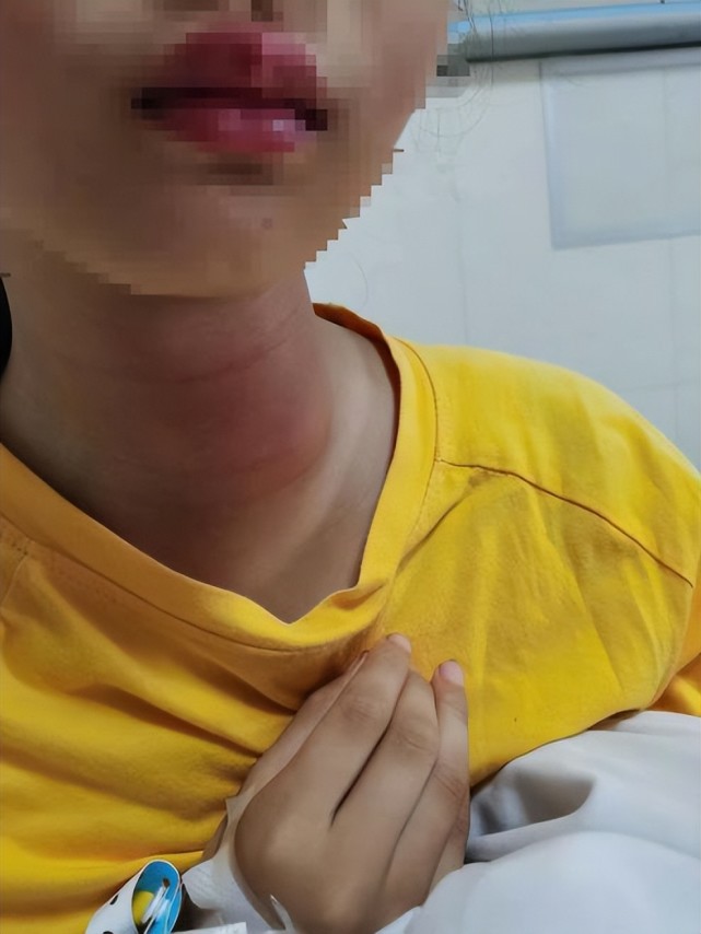 急性甲状腺炎 腾讯网