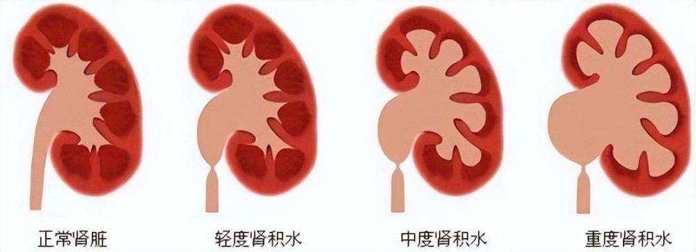 肾积水有哪些症状身体突然出现这4个症状有可能是得了肾积水