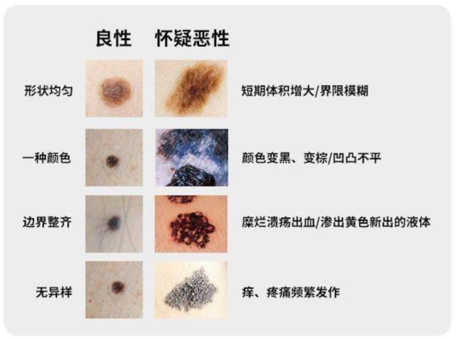 医生,我的"痣"需要切吗?