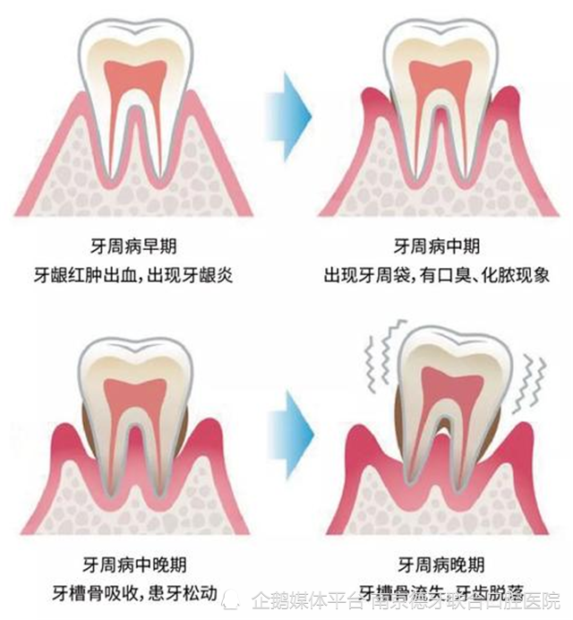 南京德牙联合口腔:牙周炎的早期症状表现有哪些?